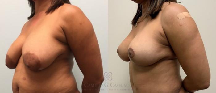 Before & After Breast Lift Case 326 View #3 View in Houston, TX