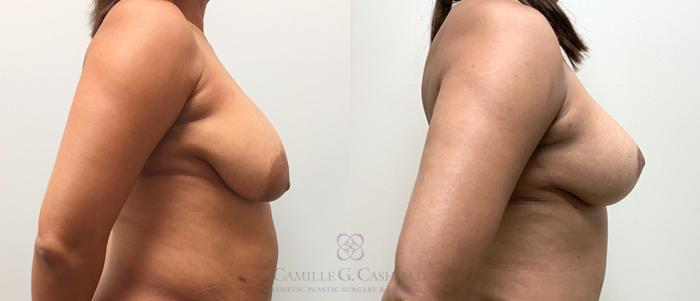 Before & After Breast Lift Case 326 View #4 View in Houston, TX
