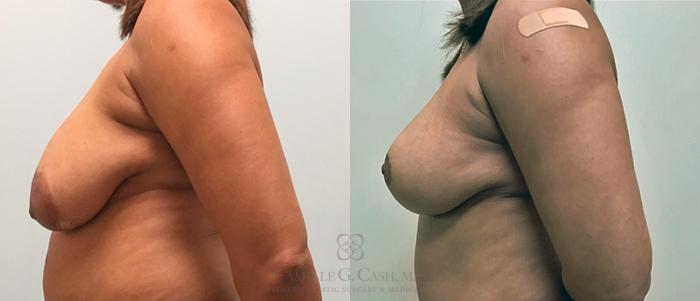 Before & After Breast Lift Case 326 View #5 View in Houston, TX