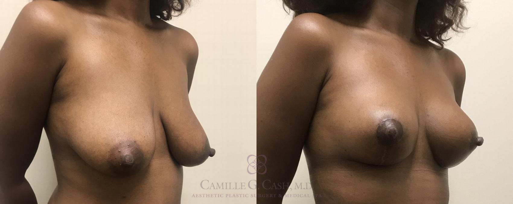 Before & After Breast Lift Case 328 View #2 View in Houston, TX