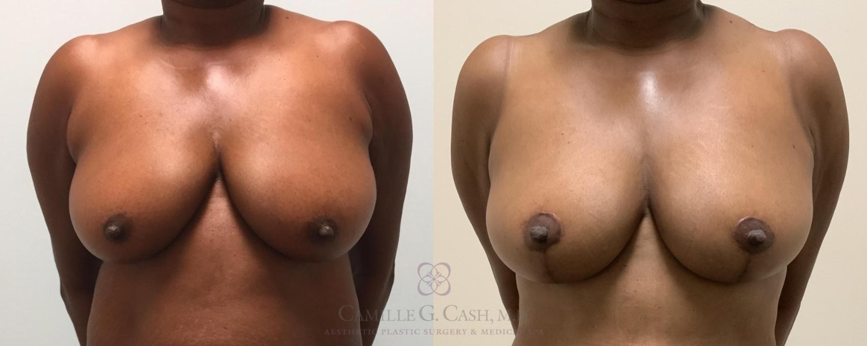 Before & After Breast Lift Case 329 View #1 View in Houston, TX
