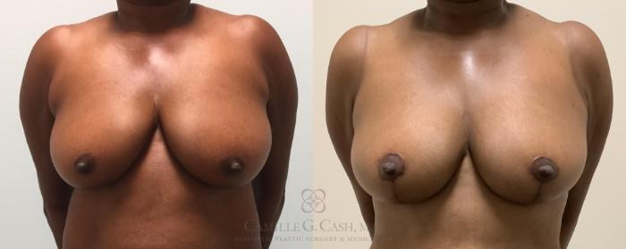 Before & After Breast Lift Case 329 View #1 View in Houston, TX