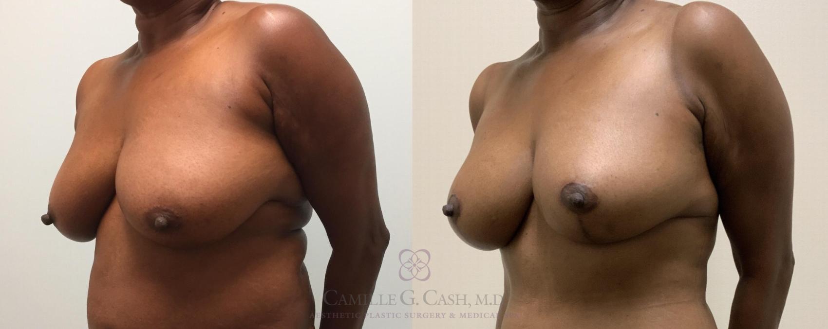 Before & After Breast Lift Case 329 View #2 View in Houston, TX