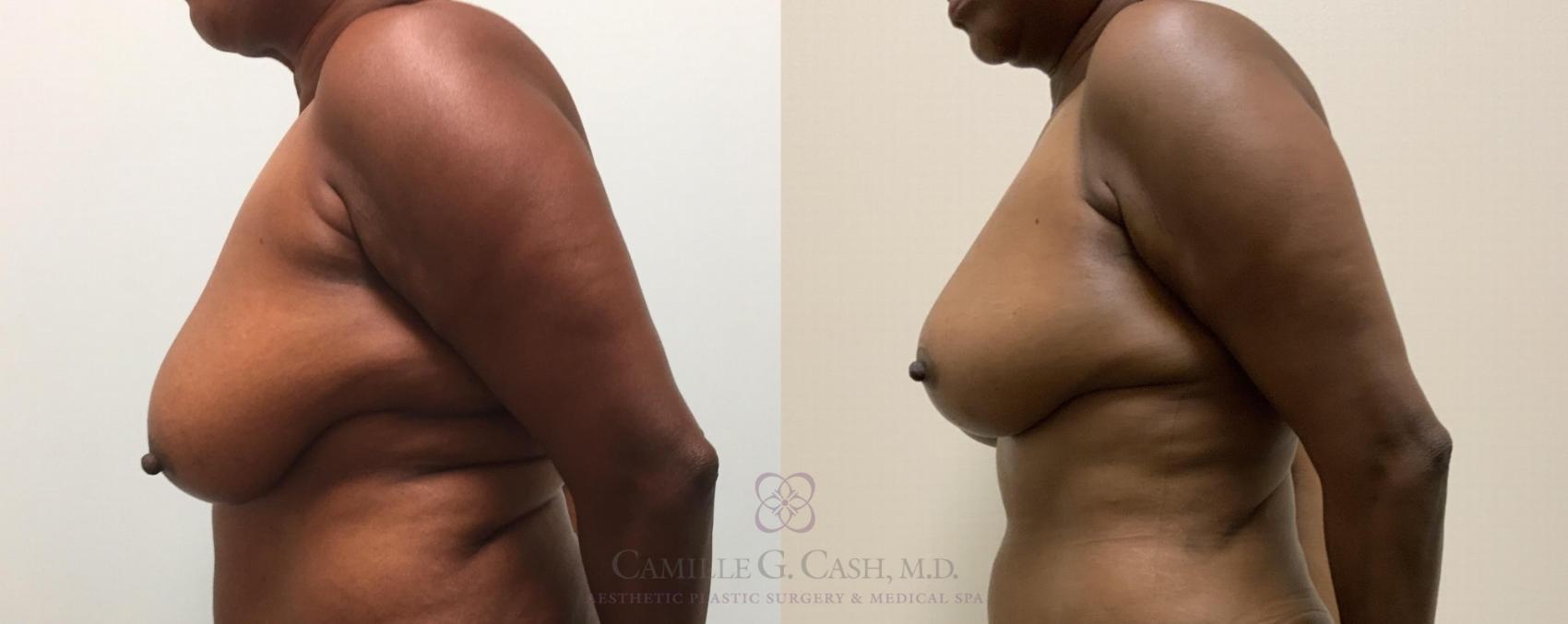 Before & After Breast Lift Case 329 View #3 View in Houston, TX