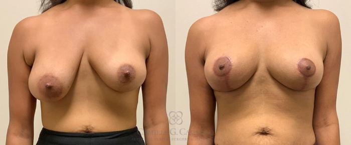 Before & After Breast Lift Case 349 View #1 View in Houston, TX