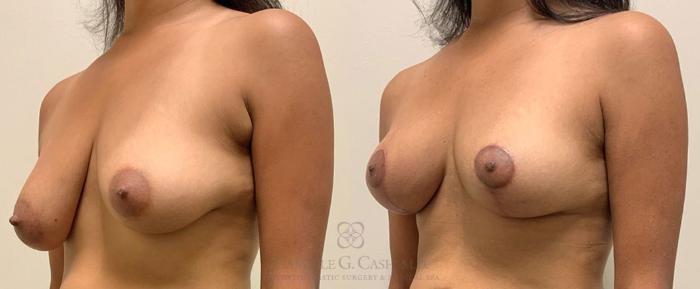 Before & After Breast Lift Case 349 View #2 View in Houston, TX