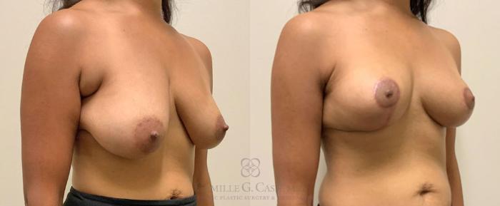 Before & After Breast Lift Case 349 View #3 View in Houston, TX