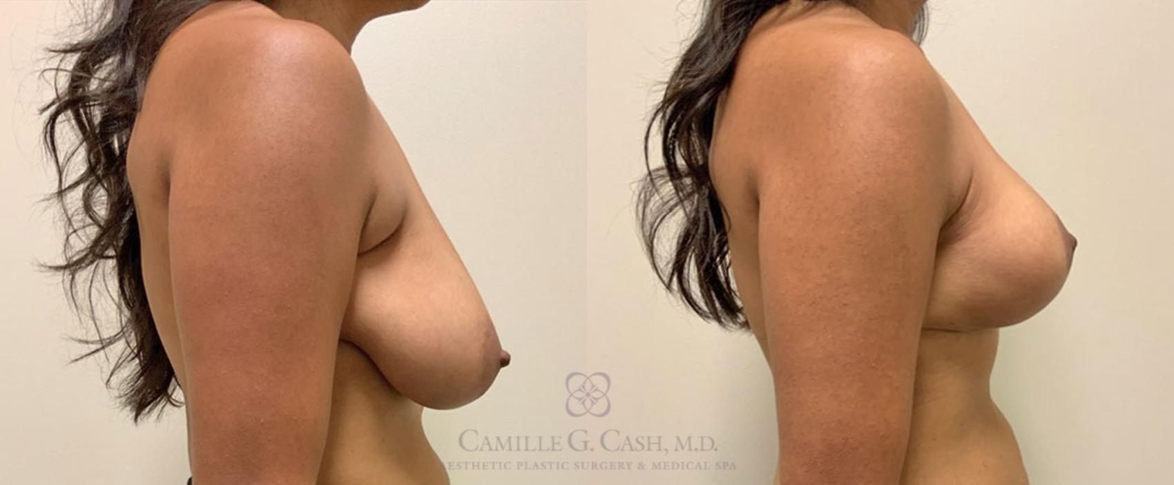 Before & After Breast Lift Case 349 View #4 View in Houston, TX