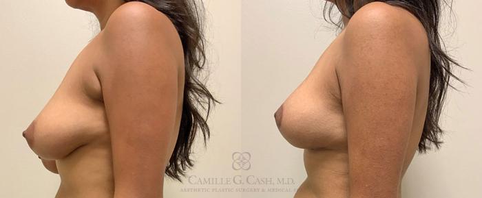 Before & After Breast Lift Case 349 View #5 View in Houston, TX
