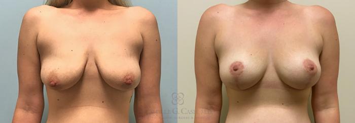 Before & After Breast Lift Case 376 View #1 View in Houston, TX