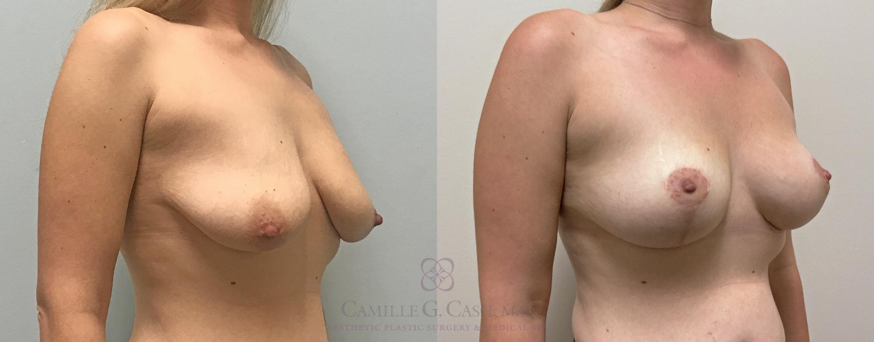 Before & After Breast Lift Case 376 View #2 View in Houston, TX