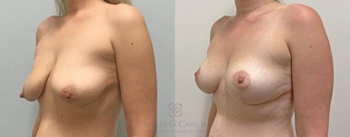 Before & After Breast Lift Case 376 View #3 View in Houston, TX