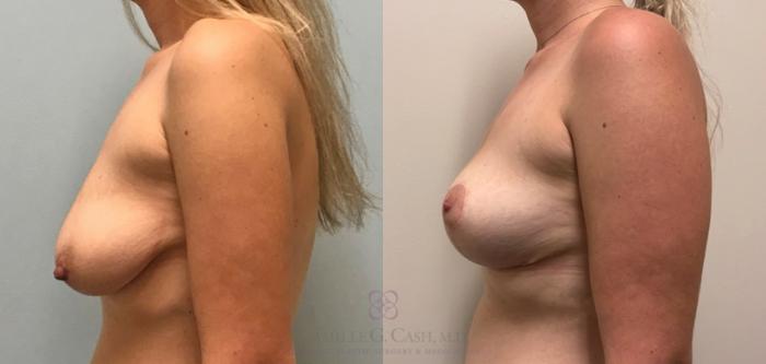 Before & After Breast Lift Case 376 View #4 View in Houston, TX