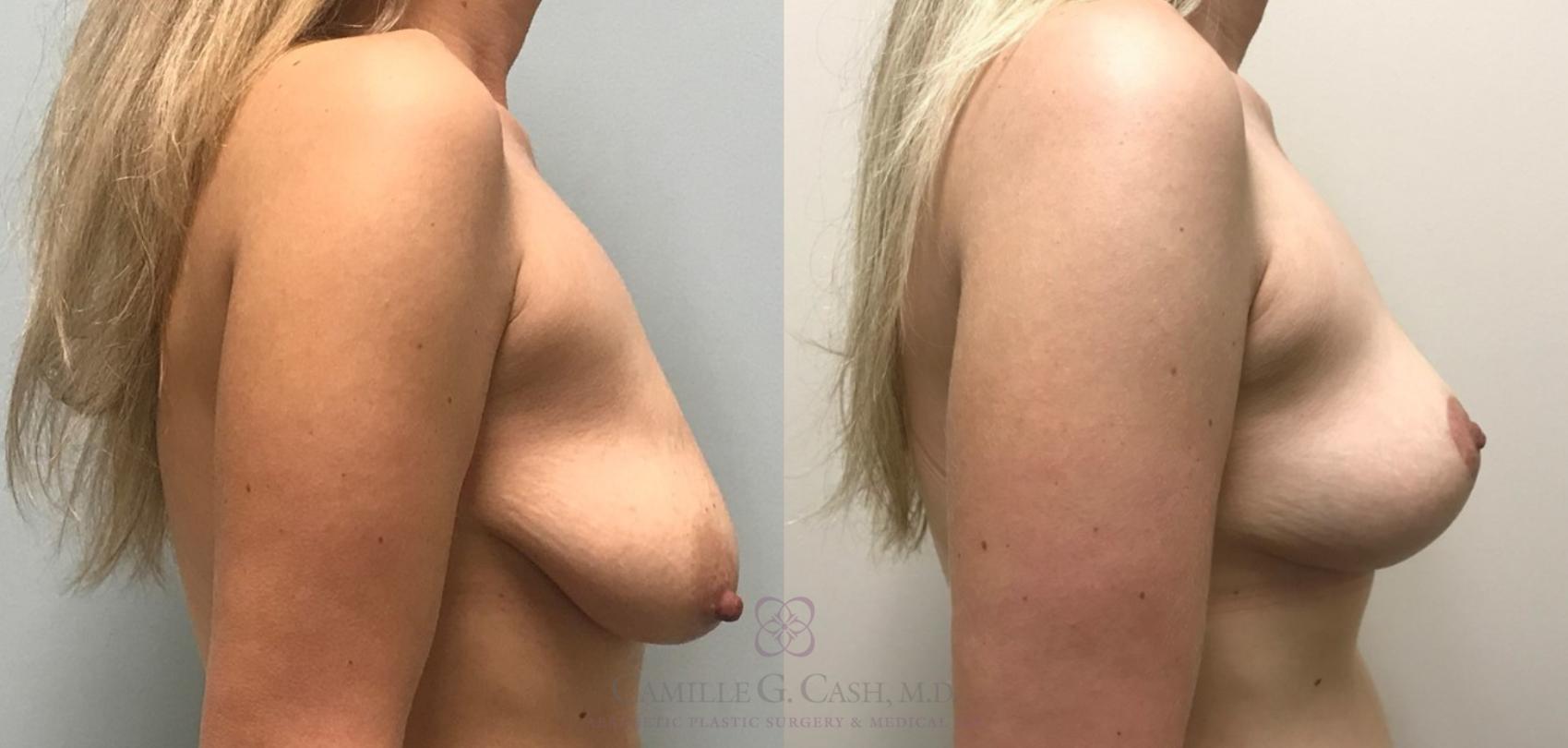 Before & After Breast Lift Case 376 View #5 View in Houston, TX