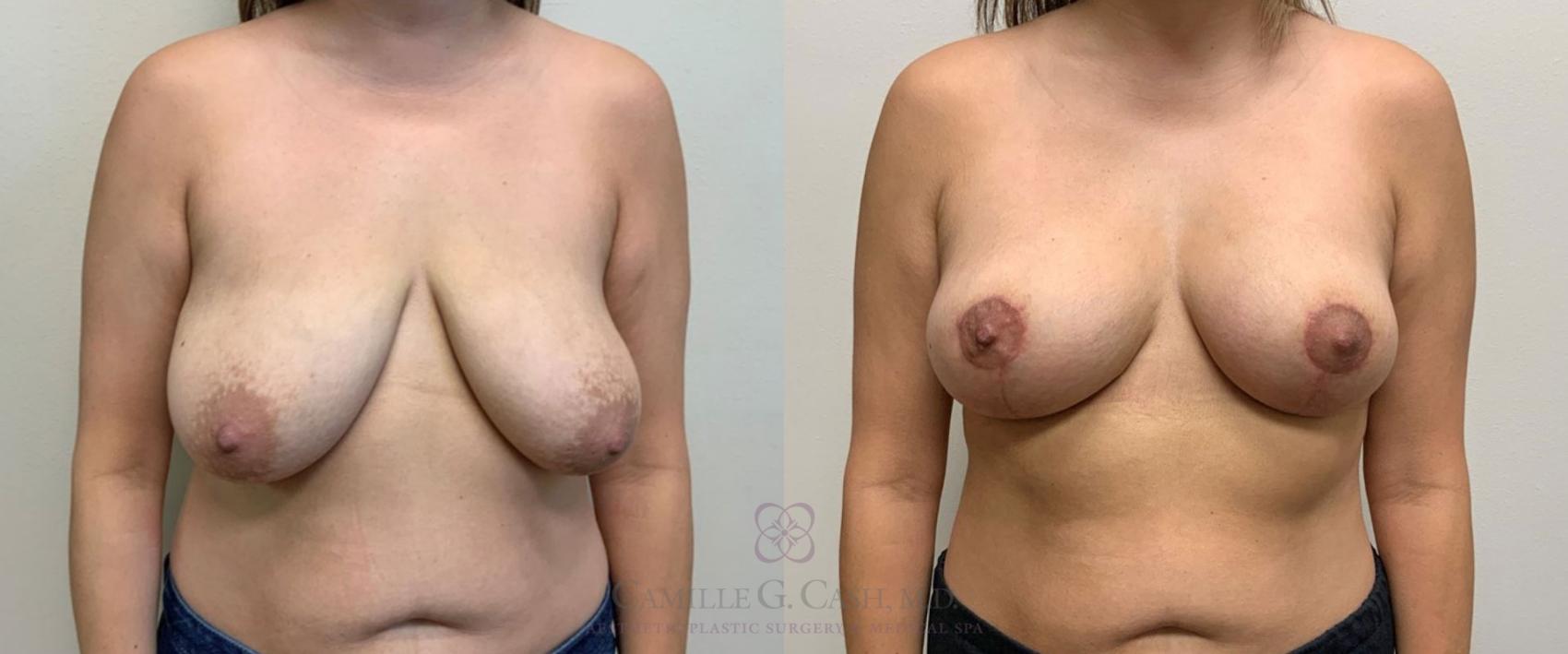 Before & After Breast Lift Case 386 View #1 View in Houston, TX