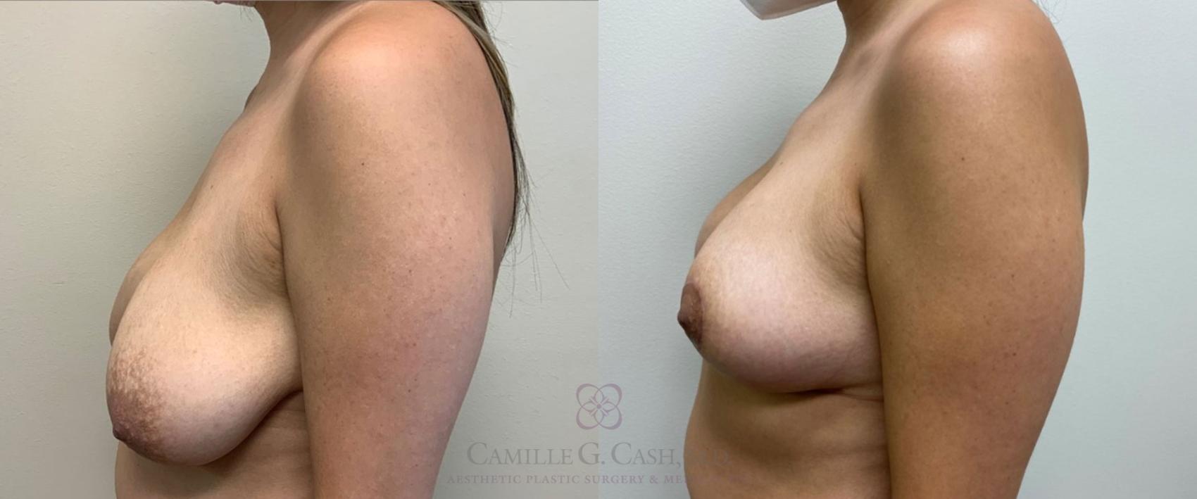 Before & After Breast Lift Case 386 View #2 View in Houston, TX