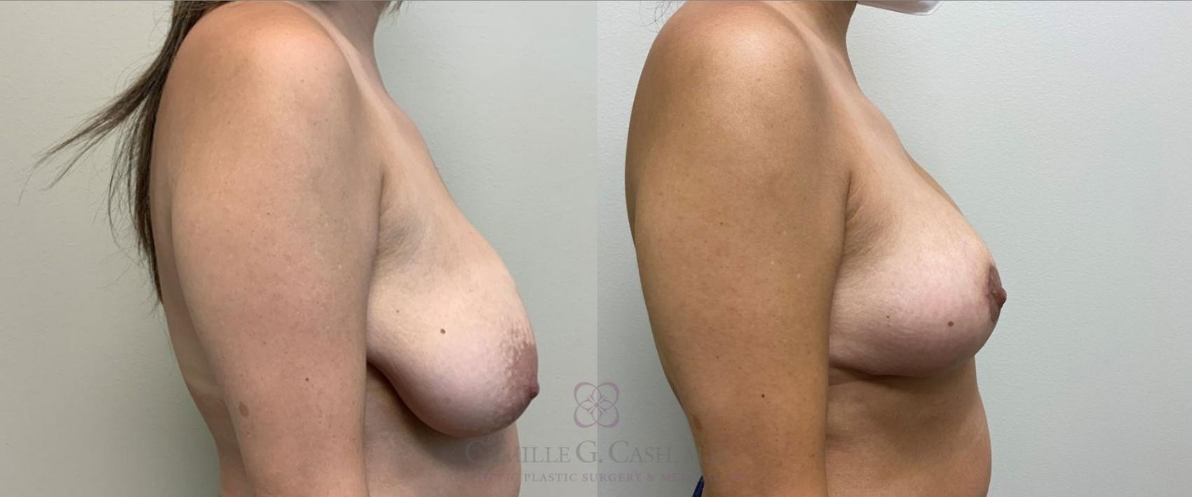 Before & After Breast Lift Case 386 View #3 View in Houston, TX