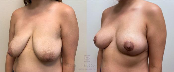 Before & After Breast Lift Case 386 View #4 View in Houston, TX