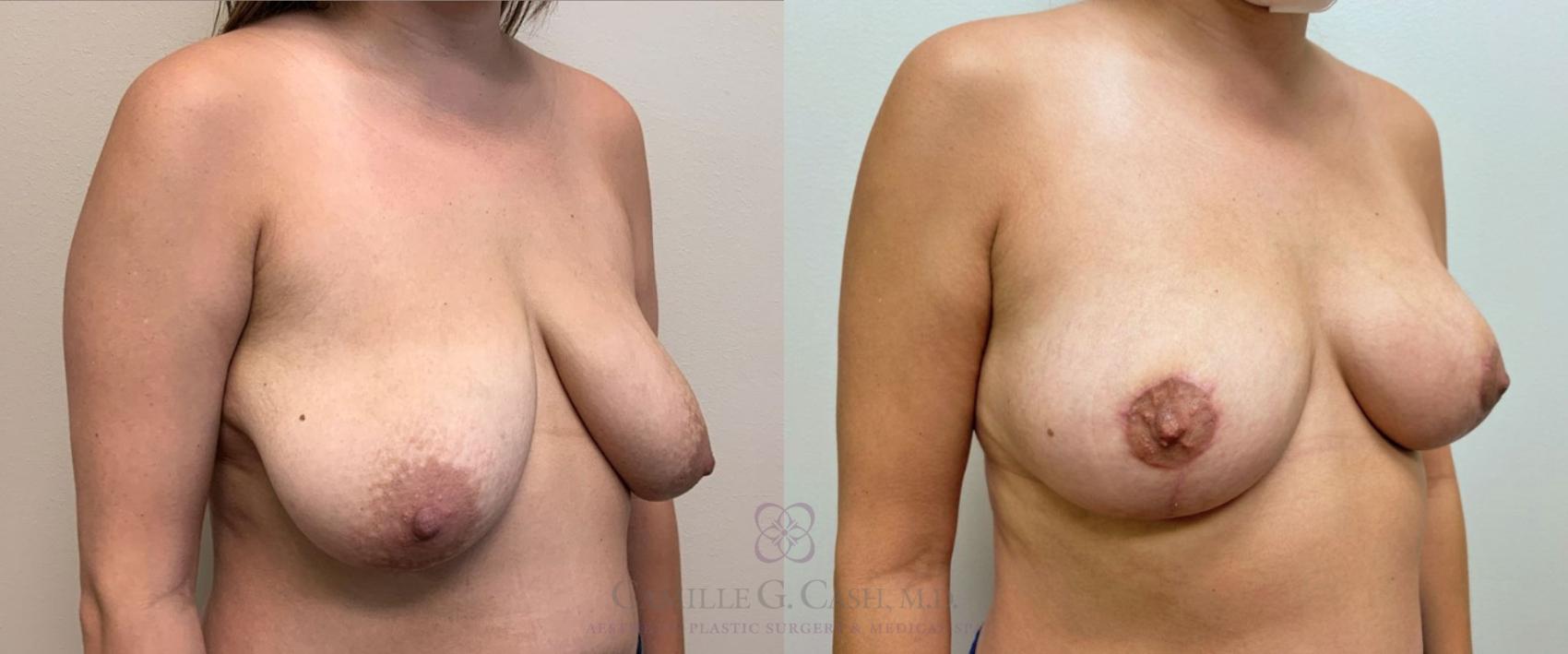 Before & After Breast Lift Case 386 View #5 View in Houston, TX