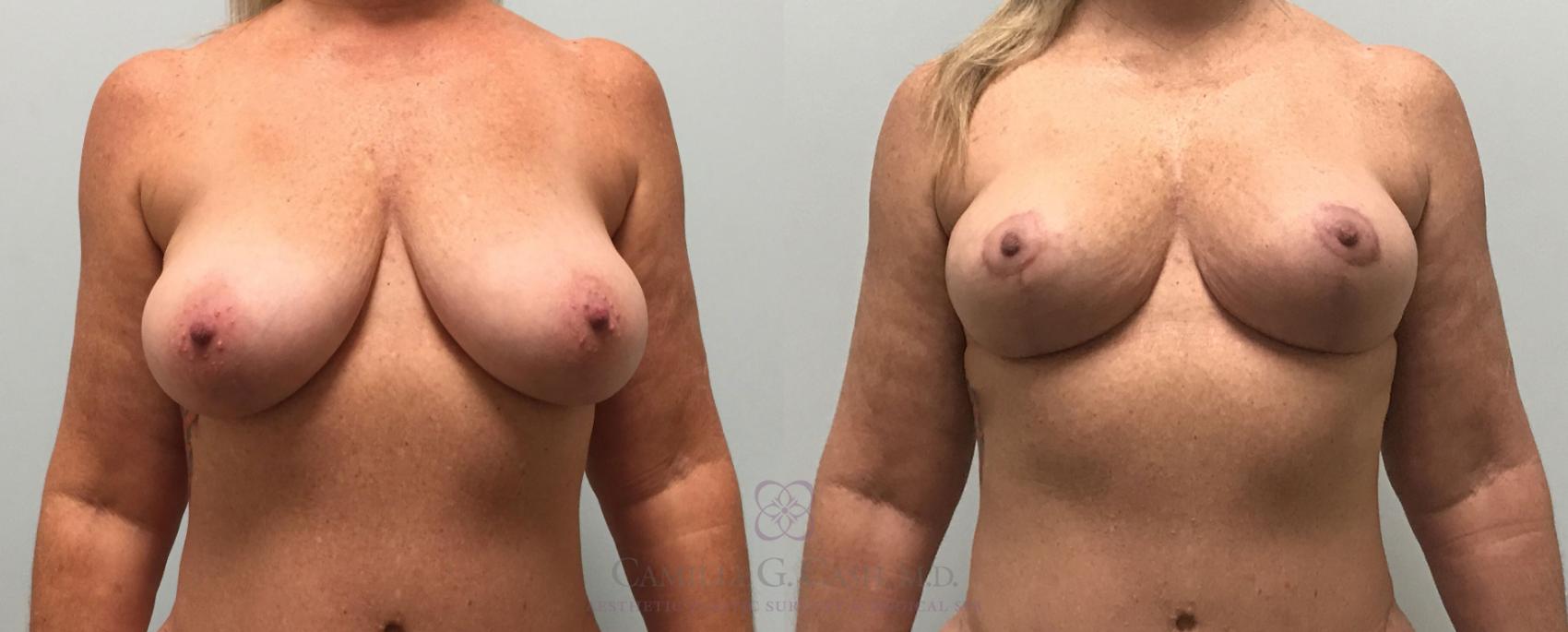 Before & After Breast Lift Case 389 View #1 View in Houston, TX