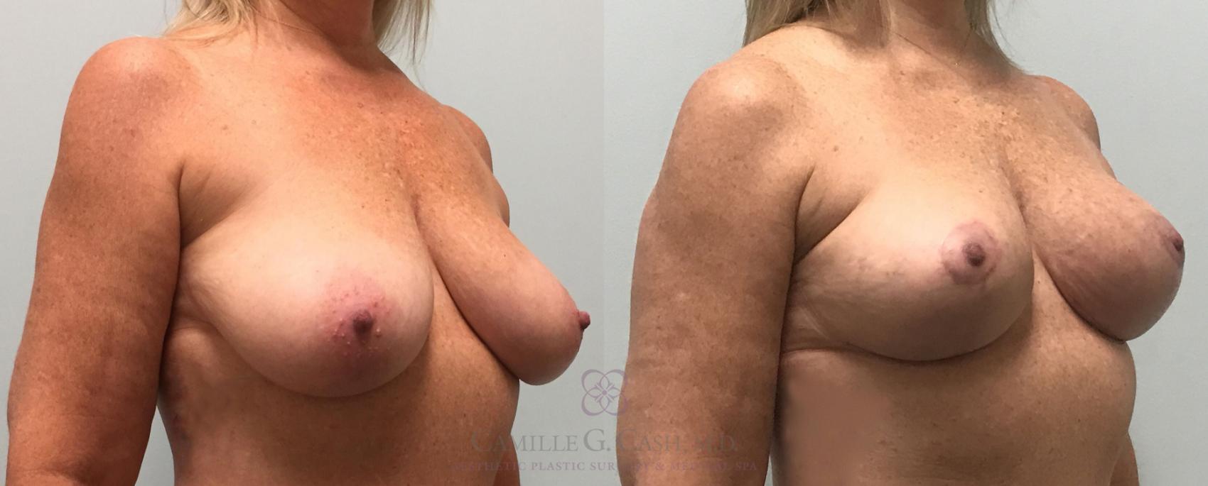 Before & After Breast Lift Case 389 View #2 View in Houston, TX
