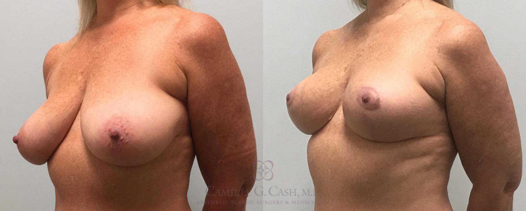 Before & After Breast Lift Case 389 View #3 View in Houston, TX