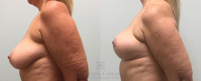 Before & After Breast Lift Case 389 View #4 View in Houston, TX