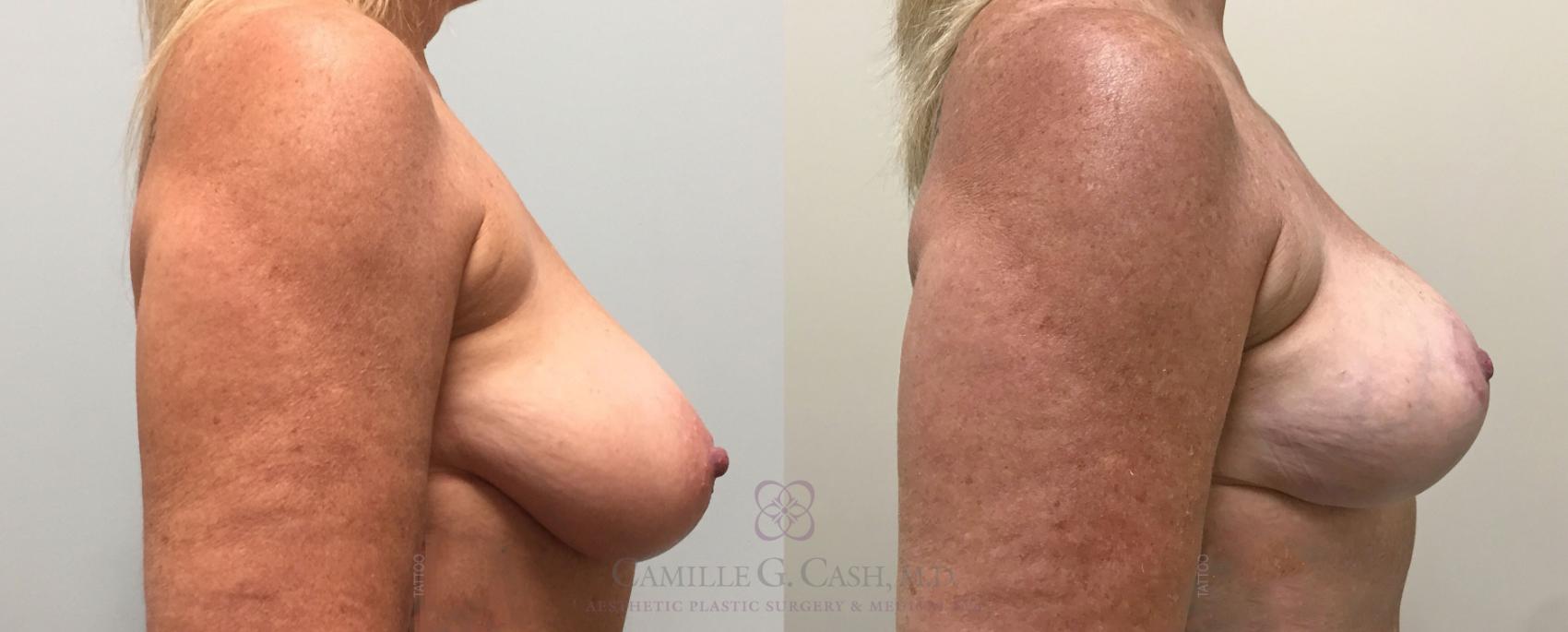 Before & After Breast Lift Case 389 View #5 View in Houston, TX