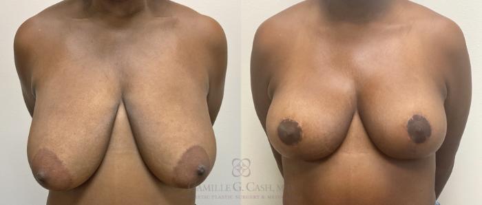 Before & After Breast Lift Case 418 View #1 View in Houston, TX