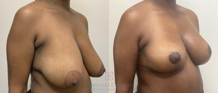Before & After Breast Lift Case 418 View #2 View in Houston, TX