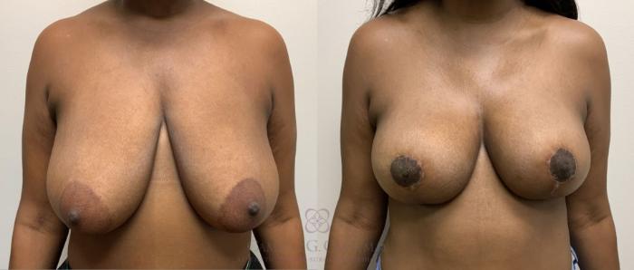 Before & After Breast Lift Case 418 View #3 View in Houston, TX