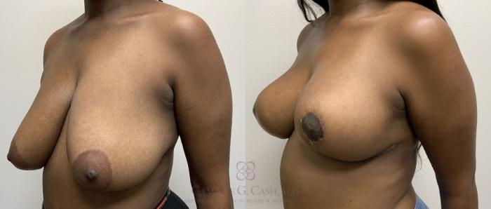 Before & After Breast Lift Case 418 View #4 View in Houston, TX