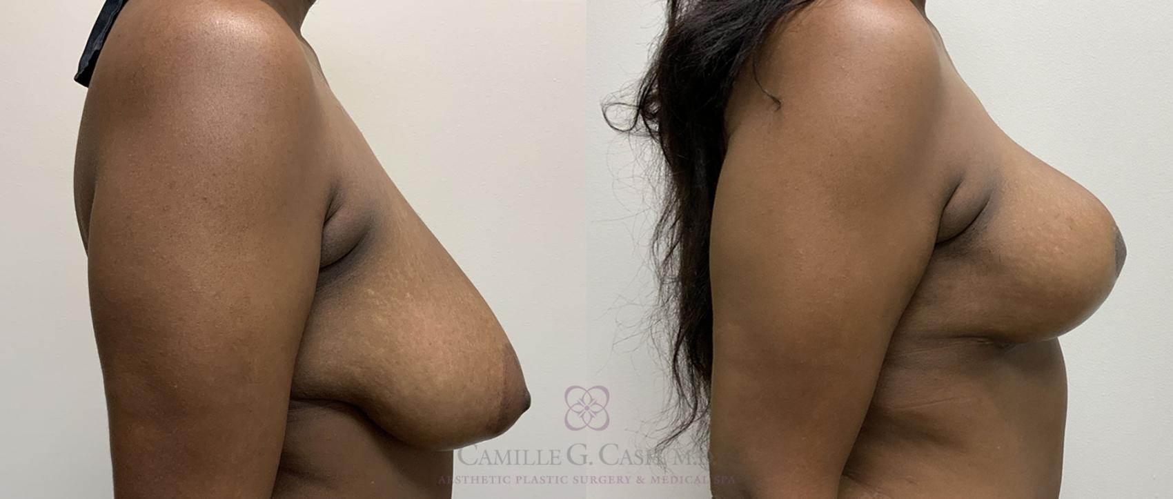 Before & After Breast Lift Case 418 View #5 View in Houston, TX