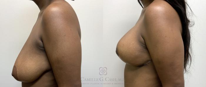 Before & After Breast Lift Case 418 View #6 View in Houston, TX