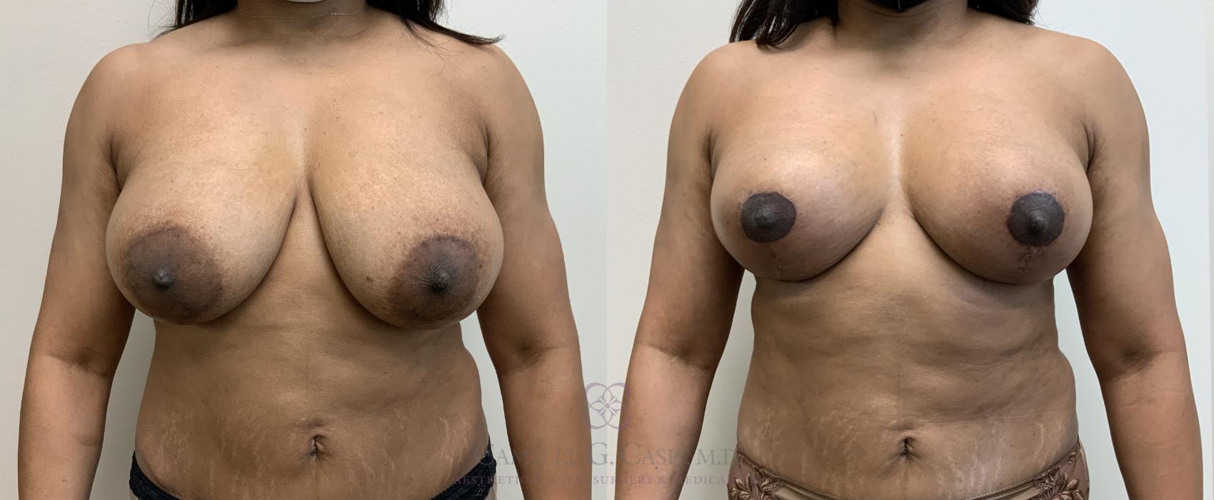 Before & After Breast Lift Case 451 Front View in Houston, TX