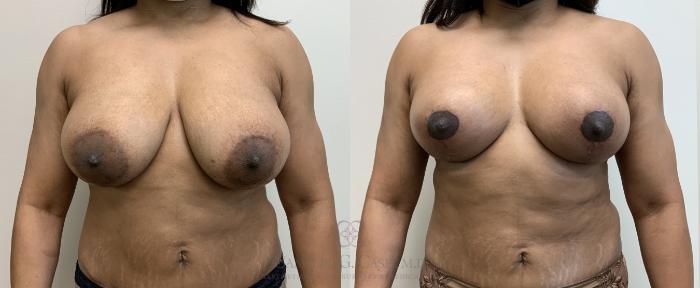 Before & After Breast Lift Case 451 Front View in Houston, TX