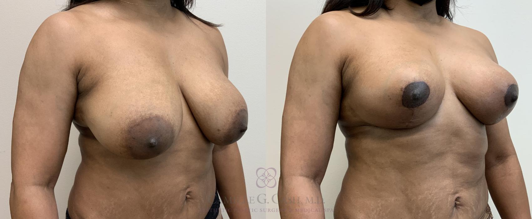 Before & After Breast Lift Case 451 Left Oblique View in Houston, TX