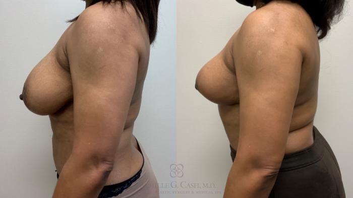 Before & After Breast Lift Case 451 Left Side View in Houston, TX
