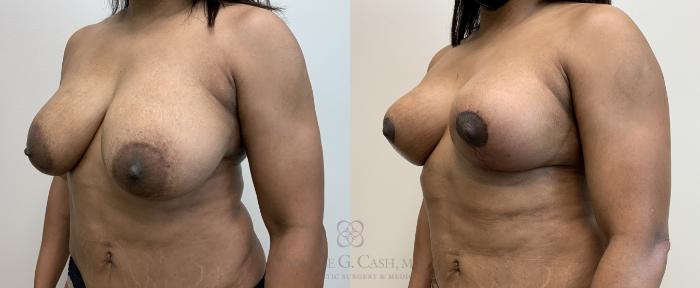 Before & After Breast Lift Case 451 Right Oblique View in Houston, TX