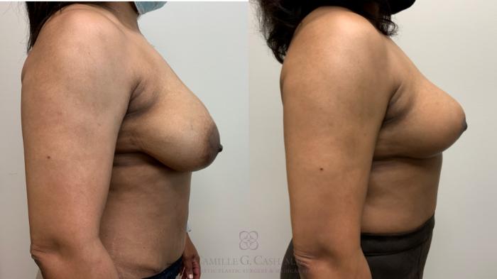 Before & After Breast Lift Case 451 Right Side View in Houston, TX