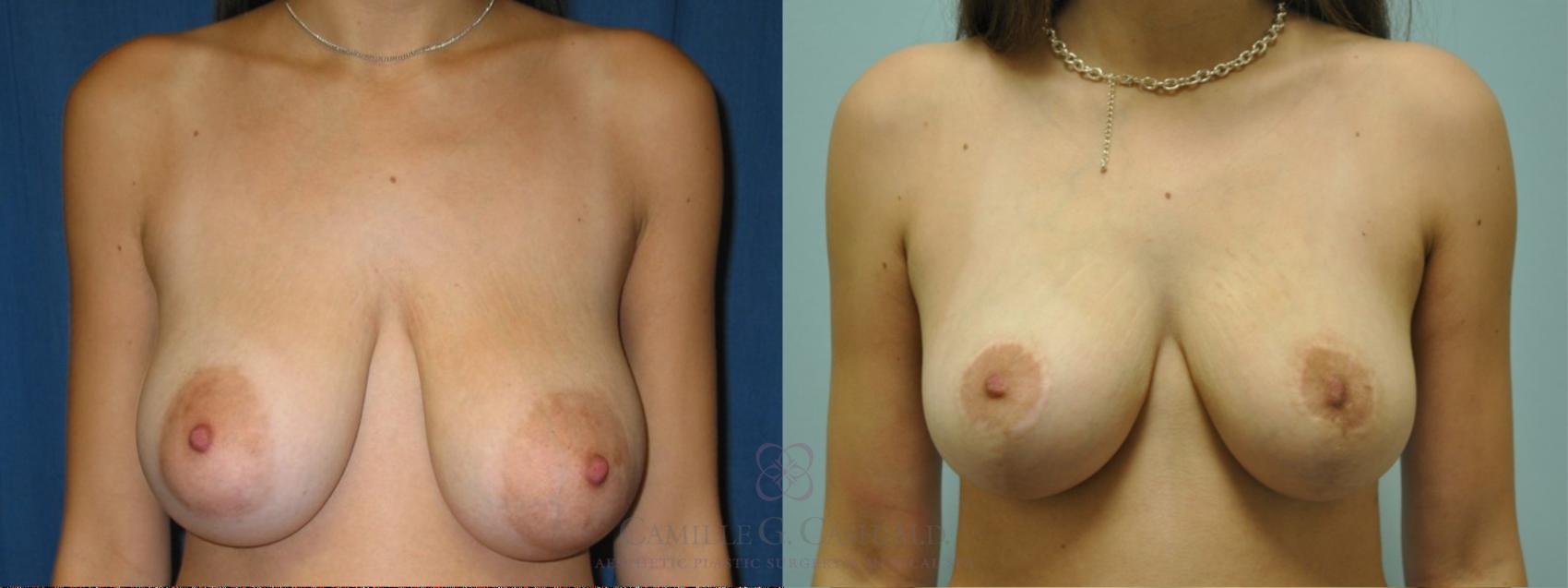 Before & After Breast Lift Case 50 Front View in Houston, TX