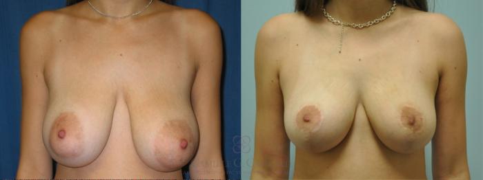 Before & After Breast Lift Case 50 Front View in Houston, TX