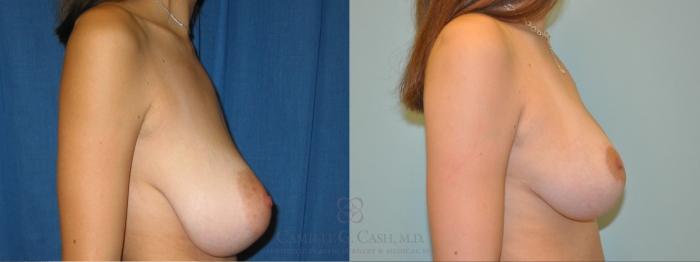 Before & After Breast Lift Case 50 Left Side View in Houston, TX