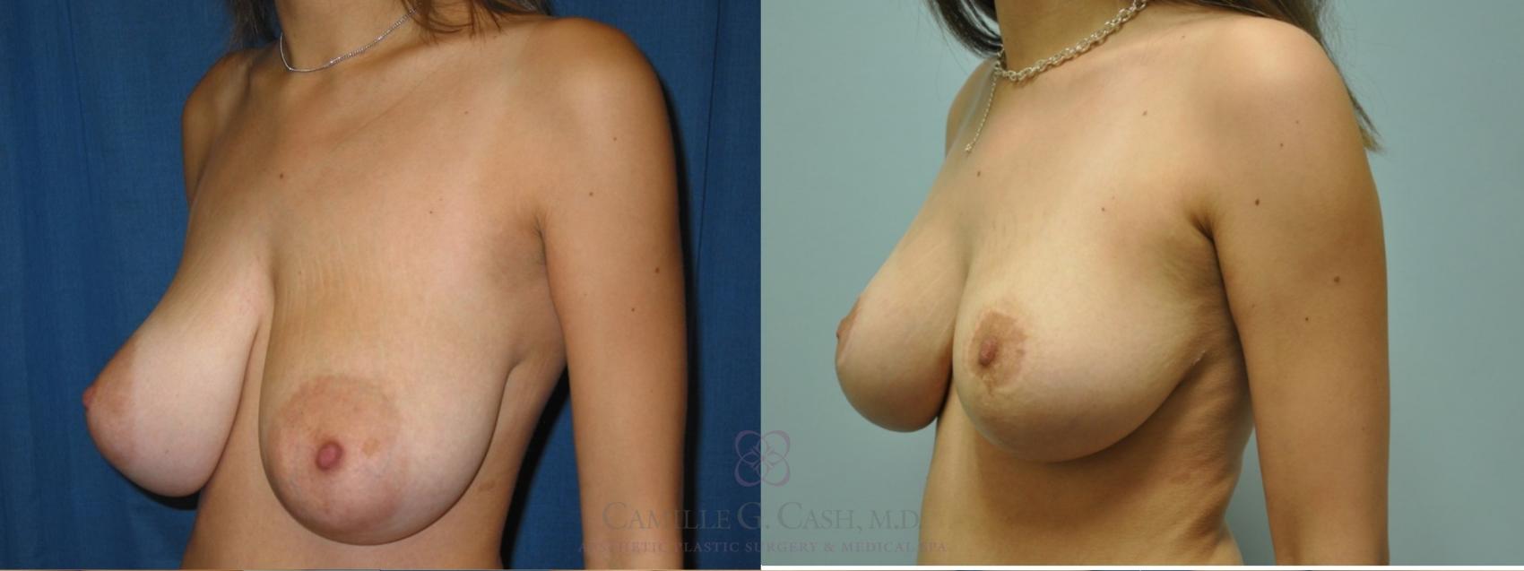 Before & After Breast Lift Case 50 Right Oblique View in Houston, TX