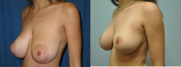 Before & After Breast Lift Case 50 Right Oblique View in Houston, TX