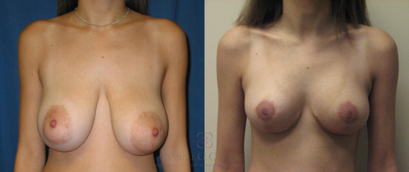 Before & After Breast Lift Case 50 View #1 View in Houston, TX