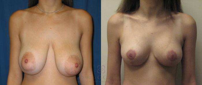 Before & After Breast Lift Case 50 View #1 View in Houston, TX