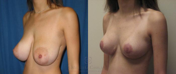 Before & After Breast Lift Case 50 View #3 View in Houston, TX