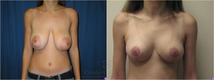 Before & After Breast Lift Case 50 View #4 View in Houston, TX