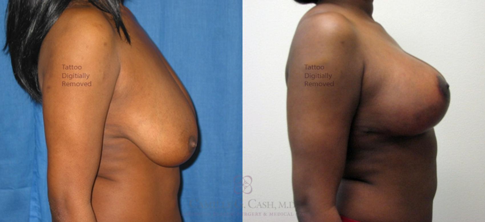 Before & After Breast Lift Case 51 Left Side View in Houston, TX